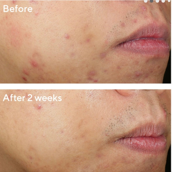 Murad Deep Relief Acne Treatment